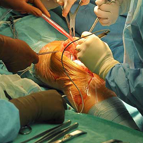 Knee Replacement Surgery - Dr. Ganesh Navaneedhan