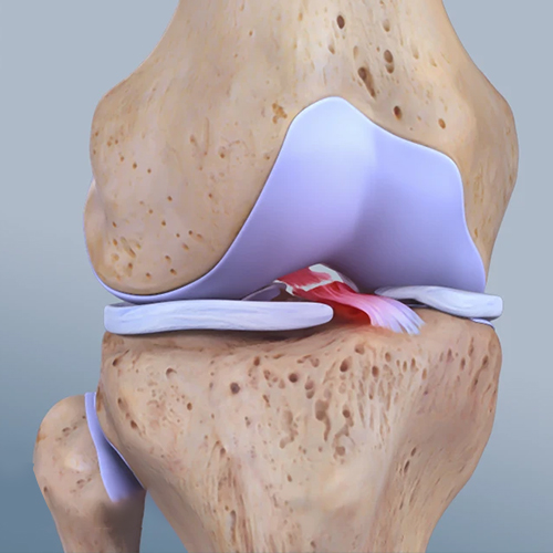 Anterior cruciate ligaments (ACL) - Dr. Ganesh Navaneedhan