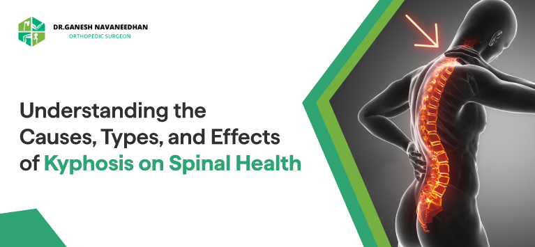 Understanding the Causes, Types, and Effects of Kyphosis on Spinal Health