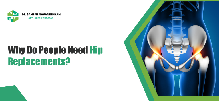 Understanding Hip Replacement: Types, Importance, and Factors to Consider