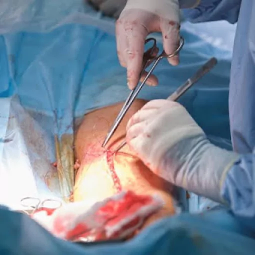 Revision Knee replacement surgery - Dr. Ganesh Navaneedhan